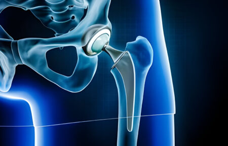 Protesi all'anca e riabilitazione